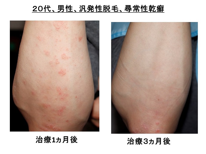 汎発性脱毛　病院